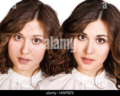 Vergleich-Porträt des jungen Mädchens mit problematischer Haut vor und nach Behandlung und Make-up. Stockfoto