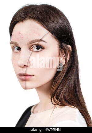 Vergleich-Porträt des jungen Mädchens mit problematischer Haut vor und nach Behandlung und Make-up. Stockfoto