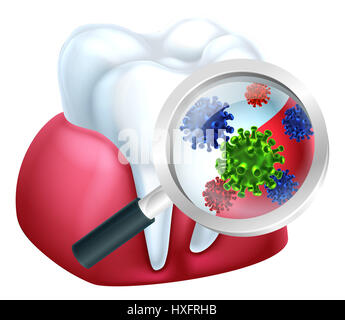 Eine zahnärztliche medizinische Illustration von Bakterien auf einem Zahn und Zahnfleisch wird vergrößert Stockfoto