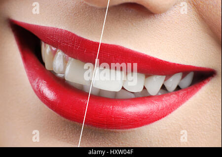 Vor und nach dem Schuss von Zahnweiß-rote Lippen Frau Stockfoto