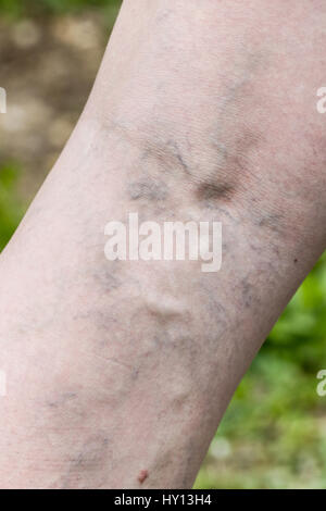 Frau mit schmerzhaften Krampfadern und Besenreisern an den Beinen. Gefäßerkrankungen, Krampfadern Probleme, schmerzhafte unästhetisch Erkrankung Konzept. Stockfoto