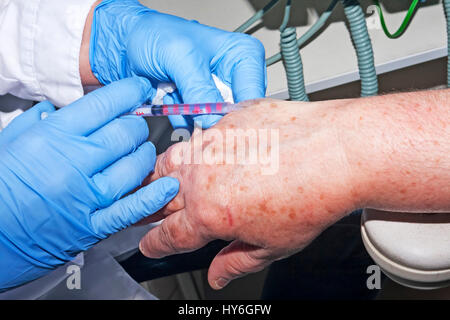 Mikrochirurgie: Hautarzt Arzt führt führt Lokalanästhesie in der hand, um Hautkrankheiten zu entfernen Stockfoto