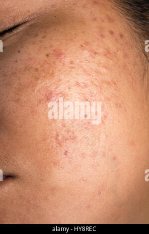 Frauen mit Nahaufnahme für problematische Haut und Akne-Narben Stockfoto