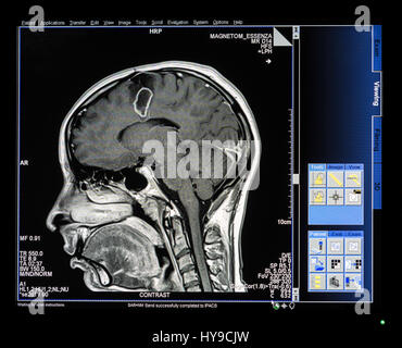 MRI Scan Monitor mit Scan-Bild des Kopfes Stockfoto