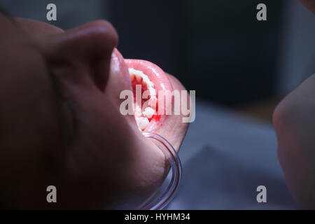 Patienten im Büro von Dentalhygienikerinnen bekommen Zähne gereinigt von Zahnstein und Plaque, Blutungen, Parodontose zu verhindern. Dental-Hygiene, schmerzhafte pro Stockfoto