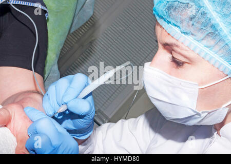 Mikrochirurgie: Hautarzt Chirurg entfernt Hautkrankheiten Stockfoto