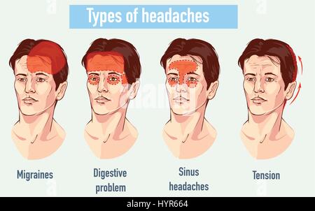Abbildung über Kopfschmerzen 4 Typ auf verschiedenen Bereich der Kopf des Patienten. Stock Vektor