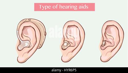 Vector Illustration einer Art von Hörgeräten Stock Vektor