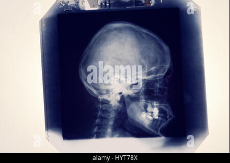 Film Röntgen Schädel von Mensch, Medizin, Wissenschaft und Gesundheitswesen Konzept, monochrome Kopie Raumfläche, Seitenansicht Stockfoto