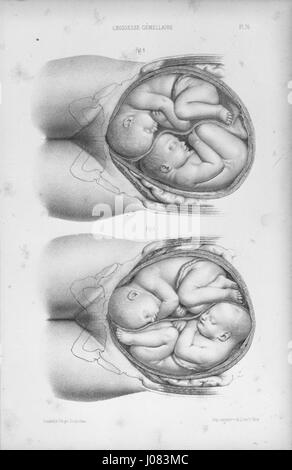Lenoir (1) Atlas Complémentaire de Tous Les Traités d'accouchements Stockfoto