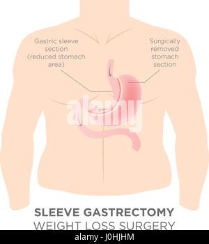 Magen, Grundnahrungsmittel Adipositaschirurgie, was in 1/4 des Magens entfernt. Stock Vektor