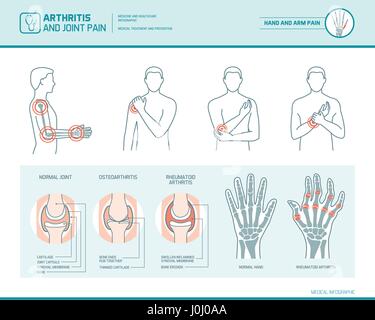 Arthritis und Schmerzen Infografik, anatomische Abbildung eines entzündet Hand und arm Stock Vektor