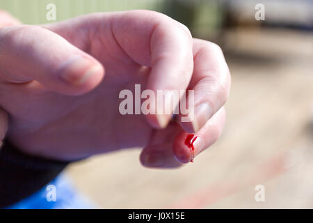 Nahaufnahme von der Frau mit Blutungen Fingernagel Verletzungen Model Release: Ja. Property Release: Nein. Stockfoto