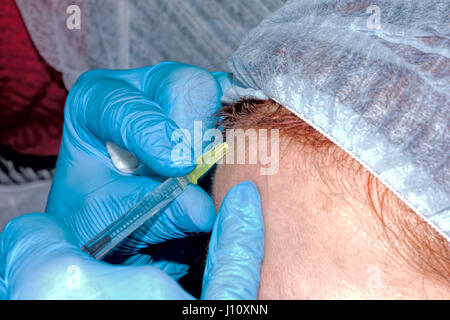 Injektion von Botx Toxin in Stirn (Tiefenschärfe) Stockfoto