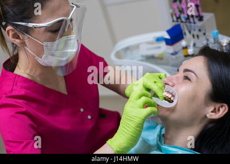 Close-up Portrait einer Patientin beim Zahnarzt in der Klinik. Zahnweiß-Verfahren. Arzt setzt dental Retraktor Stockfoto