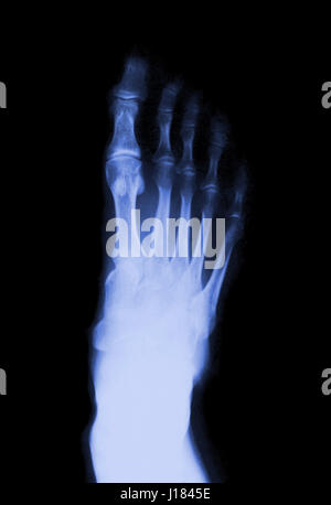 Fuß Finger auf dem Röntgenbild Stockfoto