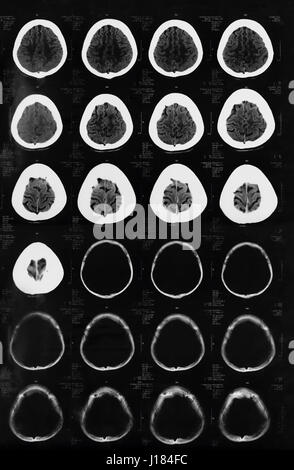 Röntgen des Gehirns Computertomographie Stockfoto