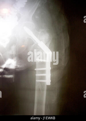 Röntgenbild der rechten Seite menschlichen Hüftfraktur Hals der Oberschenkelknochen. Reduzierung der Osteosynthese mit internen Knochen Stab öffnen und Schraube durch orthopädische Schwankung Stockfoto