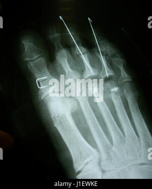 X-Ray, x-ray Bild Foto Füße Vorderansicht mit einer Knoblauchzehe nach Fraktur Stockfoto