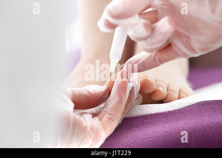 Schmerzlindernde Injektion. Chirurgische Entfernung von eingewachsenen Nagel. Injektion an den Zehen des Fußes. Der Arzt injiziert ein Analgetikum in der Frau Zehe. Stockfoto