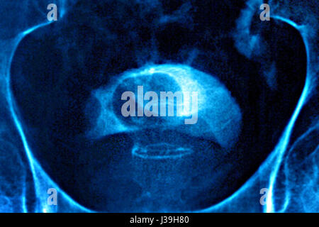 PROSTATA-ADENOM, X-RAY Stockfoto