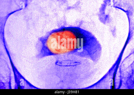 PROSTATA-ADENOM, X-RAY Stockfoto