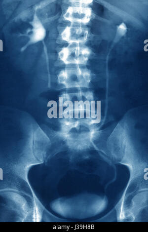 NIEREN-KOLIK, X-RAY Stockfoto