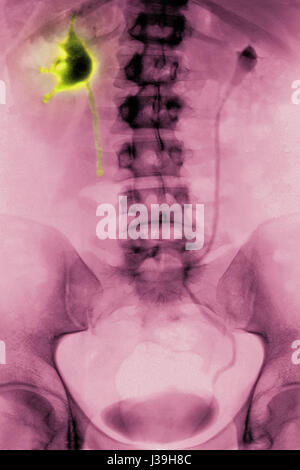 NIEREN-KOLIK, X-RAY Stockfoto