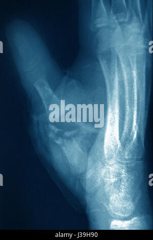 GEBROCHENEN HAND, X-RAY Stockfoto