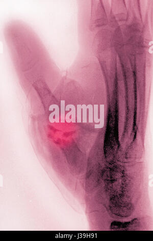 GEBROCHENEN HAND, X-RAY Stockfoto