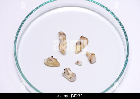 Fragmente eines menschlichen Zahnes nach der Extraktion in einer Petrischale. Stockfoto