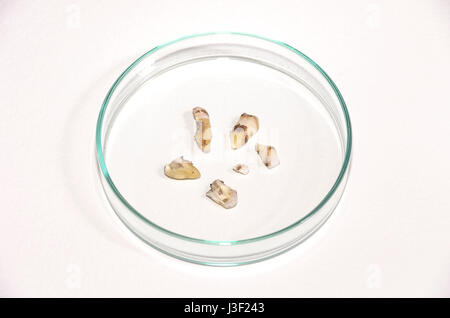 Fragmente eines menschlichen Zahnes nach der Extraktion in einer Petrischale. Stockfoto