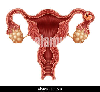 Eileiterschwangerschaft oder Eileiter schwanger Komplikation medizinischer Geburtshilfe und Gynäkologie Konzept als ein menschlicher Embryo im Eileiter implantiert. Stockfoto