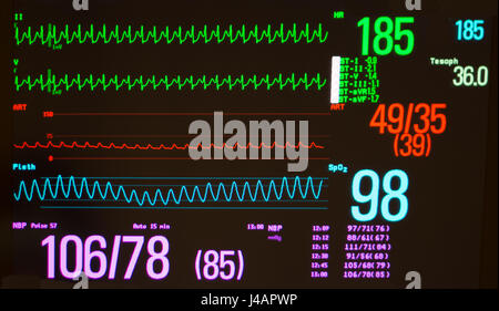 Schwarzer Monitor mit ventrikulären Knoten reentrant Tachykardie /AVNRT (grüne Linien), arteriellen Blutdruck (rot) und der Sauerstoffsättigung (blau) Stockfoto