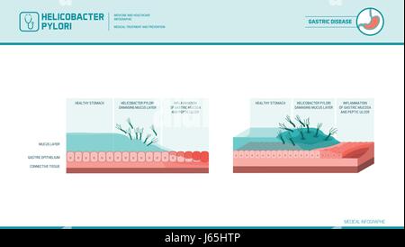 Helicobacter Pylori Infektion Magen, wodurch Schleimhaut Schaden und Magengeschwür, medizinische illustration Stock Vektor