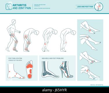 Fußschmerzen, Bein Schmerzen und Arthritis Infografik: Entzündung Spots, Schmerzregionen und Highheels Schaden Stock Vektor