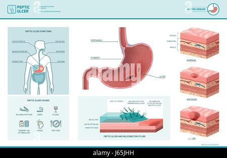 Verdauungs-Geschwür und Helicobacter Pylori Infografik mit Symptomen und Ursachen, Magen Kreuz Abschnitt Diagramm, medizinische illustration Stock Vektor