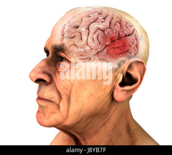 Gehirn, degenerativen Erkrankungen, Alzheimer, Parkinson, menschliche Körper, Gesicht. Alter Mann. 3D-Rendering Stockfoto