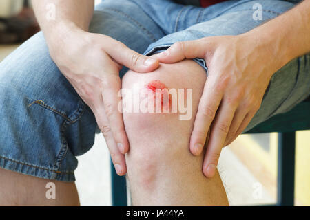 Gebrochene blutende Knie - Tiefe Kratzer auf der Haut mit blauen Flecken und nassen Spuren Stockfoto