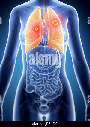 3D gerenderte Darstellung der weiblichen Anatomie - Lungenkrebs Stockfoto