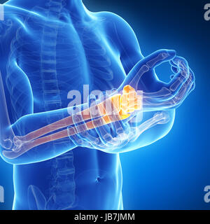 3D gerenderten Illustration - schmerzhafte Arm/Handgelenk Stockfoto