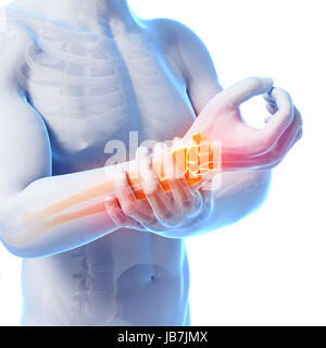 3D gerenderten Illustration - schmerzhafte Arm/Handgelenk Stockfoto