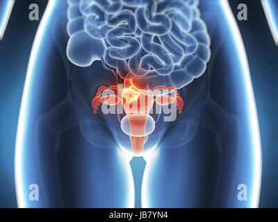 3D gerenderten Illustration - Gebärmutterkrebs Stockfoto
