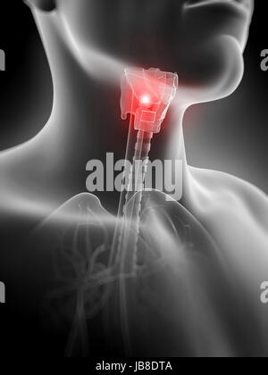 3D gerenderte Darstellung einer entzündeten Schilddrüse Stockfoto