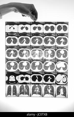 Closeup schwarz-weiß Schuss des Mannes hält Film mit Lungen CT Ergebnis Stockfoto