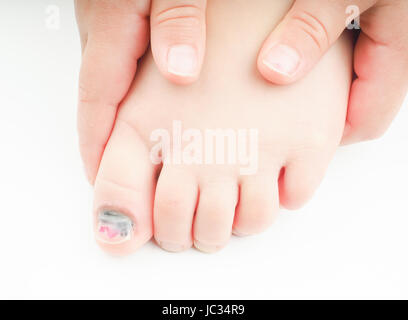 Kleine Mädchen auf ihren Fuß mit einem verletzten Großzehe halten zeigt blauen Nagel auf der Hallux mit ein klein wenig rosa Pediküre links Stockfoto