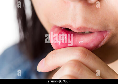 Frau mit Aphthous stomatitis Stockfoto