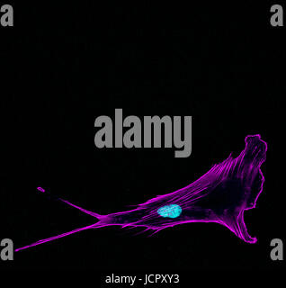 Immunfluoreszenz konfokale Abbildung von einer eindringenden metastasierendem Prostatakrebs Einzelzelle ragen Vorsprünge mit Zellskelett in violett und nucl Stockfoto