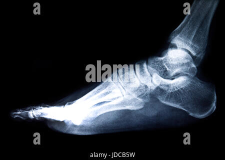 Röntgen des Fußes auf schwarzem Hintergrund Stockfoto