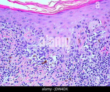 Malignes Melanom in der Hallo-Power Vergrößerung Stockfoto